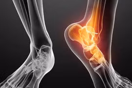 Xử lý dứt điểm giãn dây chằng cổ chân