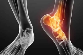 Xử lý dứt điểm giãn dây chằng cổ chân