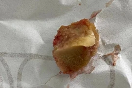 Gắp thành công mảnh xương lợn dài 1,5 cm nằm hơn một tháng trong phế quản 