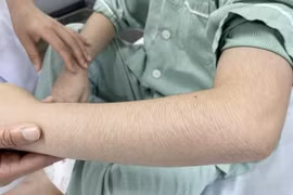 Rậm lông, béo mặt bất thường do lạm dụng corticoid