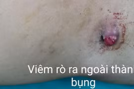 Để lâu, mảnh gỗ nằm sâu trong vùng chậu