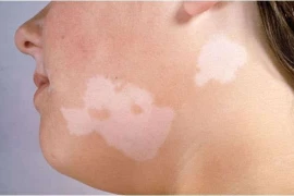 Lang ben có phải là bệnh? 