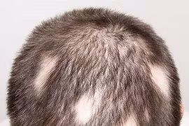 Điều trị rụng tóc từng mảng