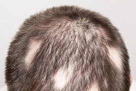 Điều trị rụng tóc từng mảng