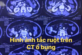 3 người phải mổ tắc ruột do ăn hồng ngâm