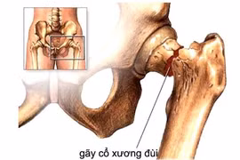 Hoại tử chỏm xương đùi có bơm tế bào gốc được không?