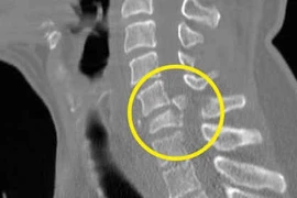 Gãy đốt sống cổ khổ suốt đời
