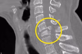 Gãy đốt sống cổ khổ suốt đời