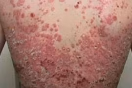 Không lạm dụng thuốc khi chữa vẩy nến	