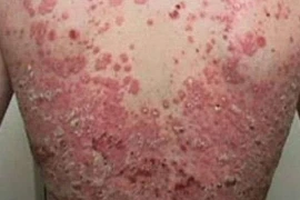 Không lạm dụng thuốc khi chữa vẩy nến	