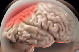  Phù não khi điều trị u