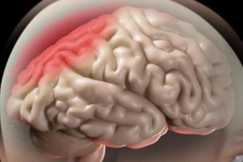  Phù não khi điều trị u