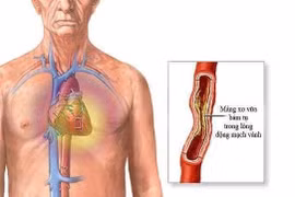 Đặt stent động mạch vành có nguy hiểm?