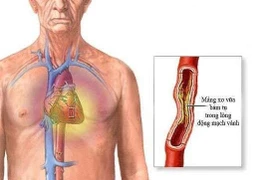 Đặt stent động mạch vành có nguy hiểm?