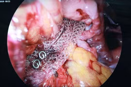 Nội soi đặt lưới nâng tử cung chữa sa sinh dục