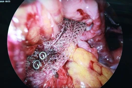 Nội soi đặt lưới nâng tử cung chữa sa sinh dục