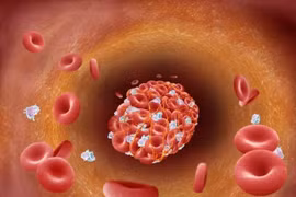 Cục máu đông có thể gây liệt