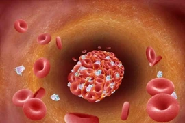 Cục máu đông có thể gây liệt