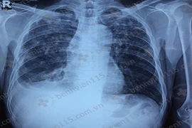 Bùng phát bệnh lao phổi ở bệnh nhân suy nhược cơ thể