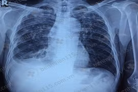 Bùng phát bệnh lao phổi ở bệnh nhân suy nhược cơ thể