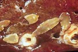 Gan xơ hóa do ký sinh trùng