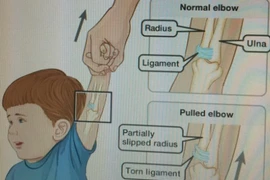 Trật khớp vì kéo trẻ một tay