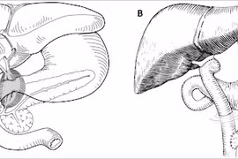 Triệu chứng u nang đường mật