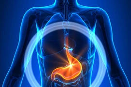 Liệt dạ dày do biến chứng đái tháo đường