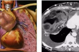 U chèn ép trung thất rất nguy hiểm