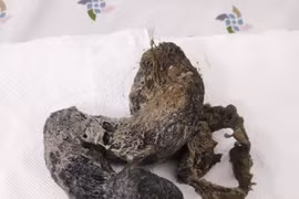 Bé 4 tuổi nhiễm trùng đường ruột vì ăn tóc