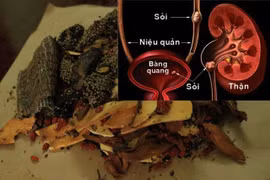 Bài thuốc đơn giản phòng chống sỏi đường tiết niệu mùa hè