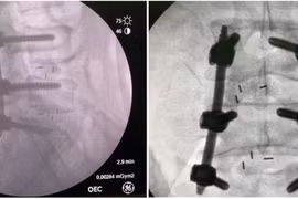 Lưu ý khi phẫu thuật cột sống ở người trẻ 