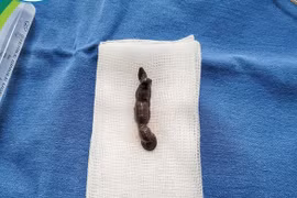 Đỉa chui đường hô hấp 