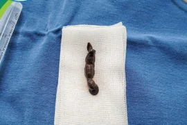 Đỉa chui đường hô hấp 