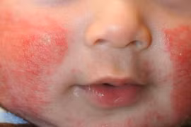 Chăm sóc trẻ bị viêm da cơ địa thế nào để tránh tái phát?