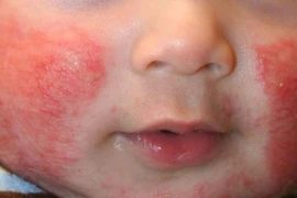 Chăm sóc trẻ bị viêm da cơ địa thế nào để tránh tái phát?