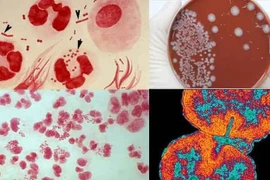 Lậu cầu gây vô sinh nam