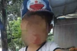 Cháu bé 5 tuổi tử vong sau nạo VA, nguyên nhân do đâu?