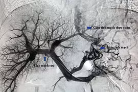 Can thiệp TIPS cứu bệnh nhân vỡ tĩnh mạch thực quản