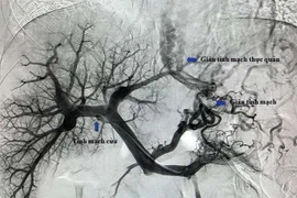 Can thiệp TIPS cứu bệnh nhân vỡ tĩnh mạch thực quản