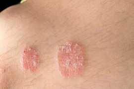 Phương pháp hỗ trợ điều trị vảy nến không dùng thuốc hiệu quả hiện nay