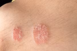 Phương pháp hỗ trợ điều trị vảy nến không dùng thuốc hiệu quả hiện nay