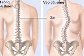 Cảnh giác với vẹo cột sống ở trẻ em