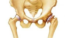 Hoại tử vô khuẩn chỏm xương đùi 