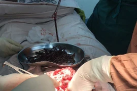 Tổn thương dạ dày vì hội chứng thích ăn dị vật kim loại 