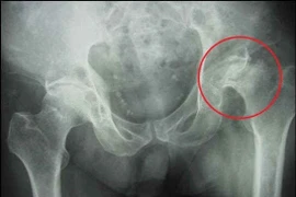 Hoại tử chỏm xương đùi do uống rượu và hút thuốc lá