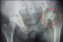 Hoại tử chỏm xương đùi do uống rượu và hút thuốc lá