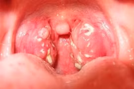 Đông y điều trị viêm amiđan 