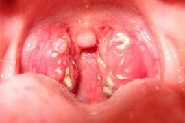 Đông y điều trị viêm amiđan 