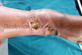 Điều trị ngứa tại nhà thành ra bệnh nặng